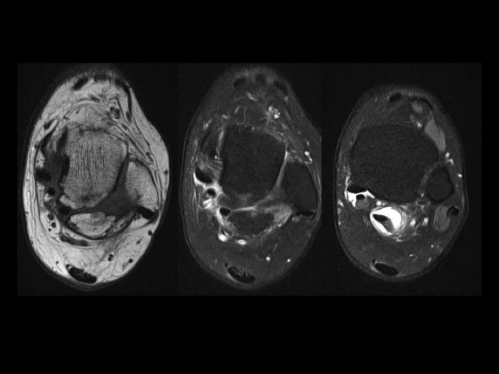 Figure 2 for case sural nerve ( RID7347 )